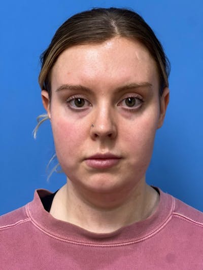Liposuction Before & After Gallery - Patient 332350 - Image 1