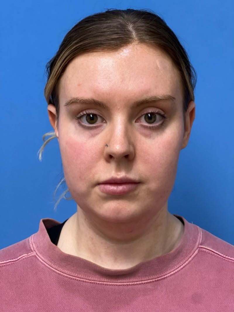 Liposuction Before & After Gallery - Patient 332350 - Image 1