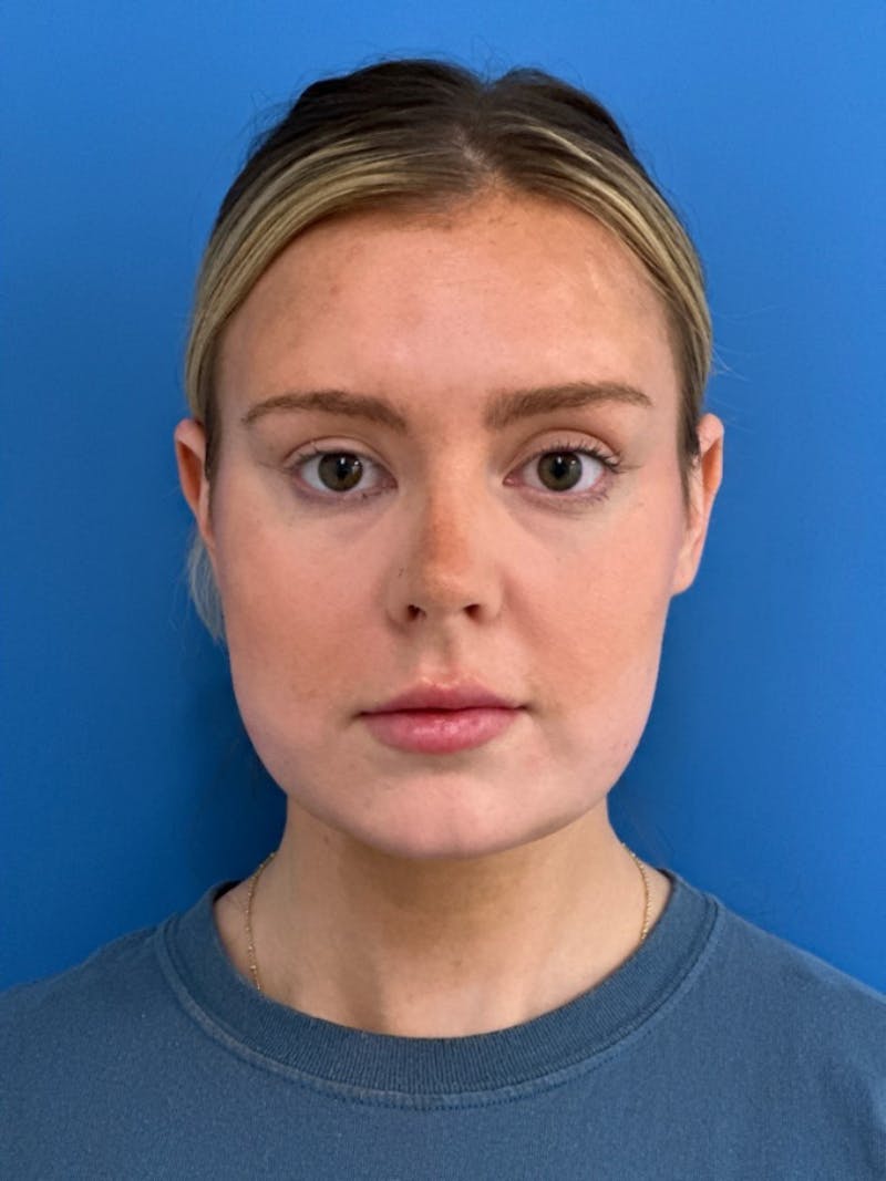 Liposuction Before & After Gallery - Patient 332350 - Image 2