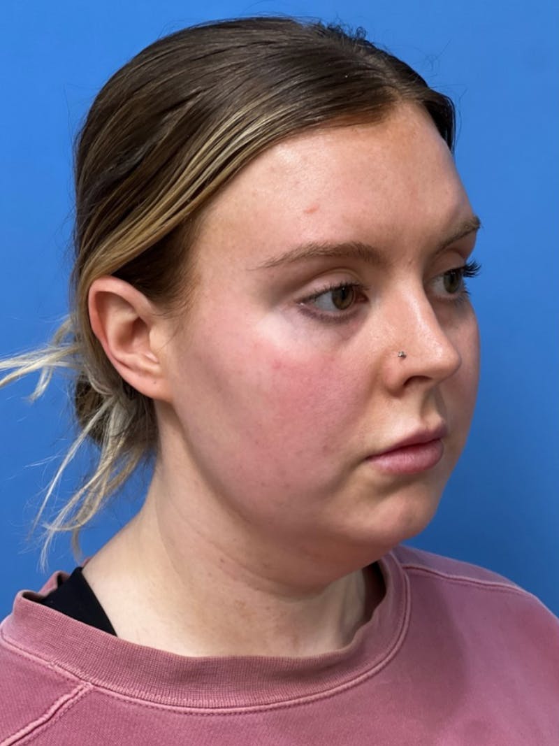 Liposuction Before & After Gallery - Patient 332350 - Image 3