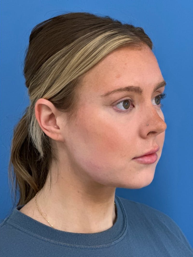 Liposuction Before & After Gallery - Patient 332350 - Image 4
