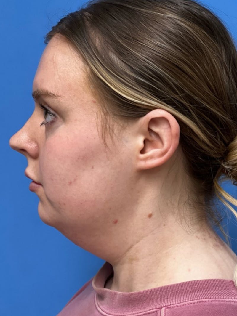Liposuction Before & After Gallery - Patient 332350 - Image 5