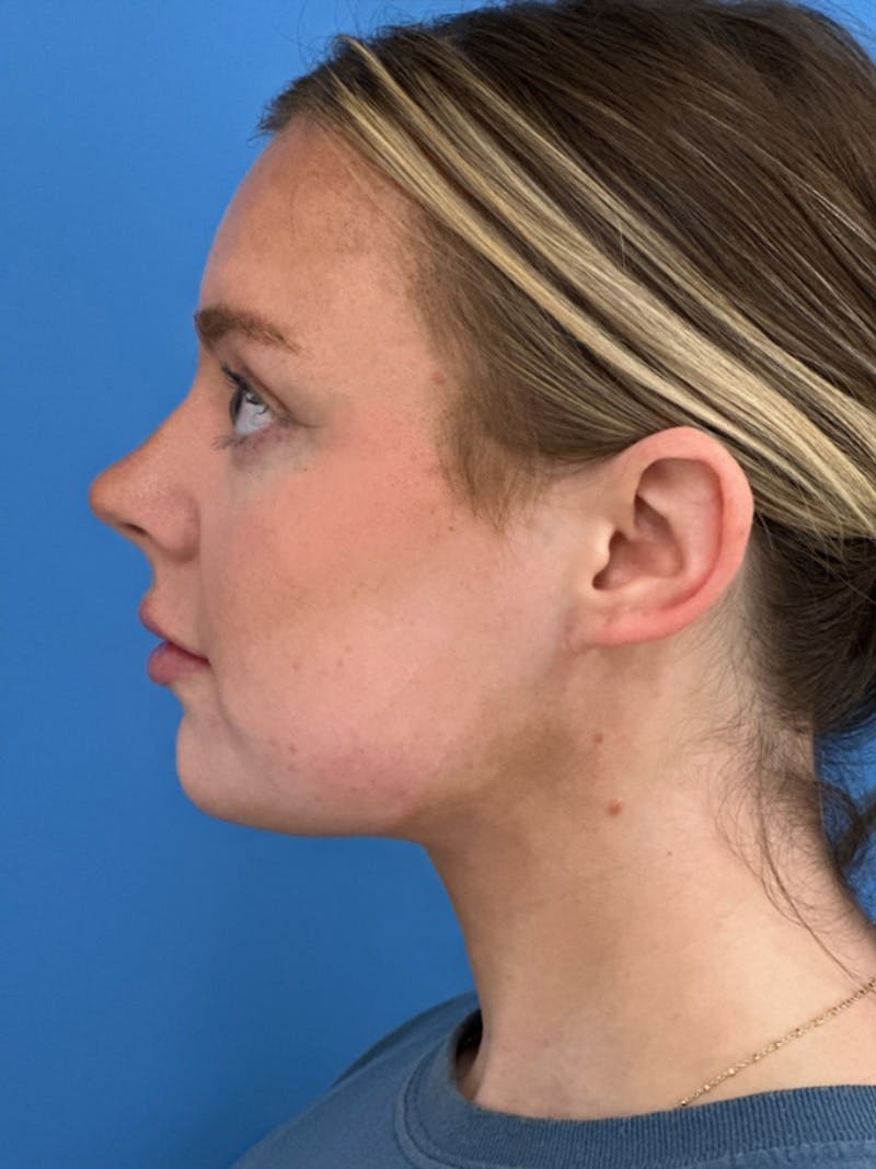 Liposuction Before & After Gallery - Patient 332350 - Image 6