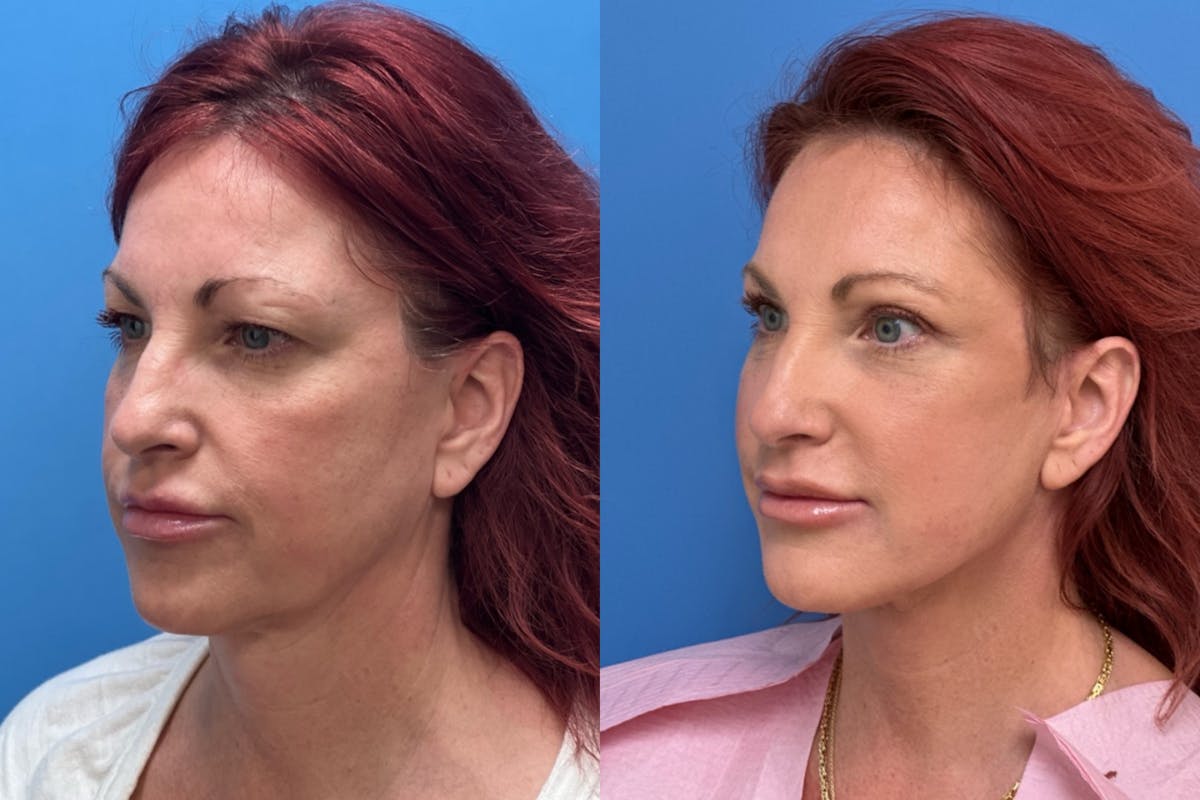 Chemical Peel Before & After Gallery - Patient 337870 - Image 2