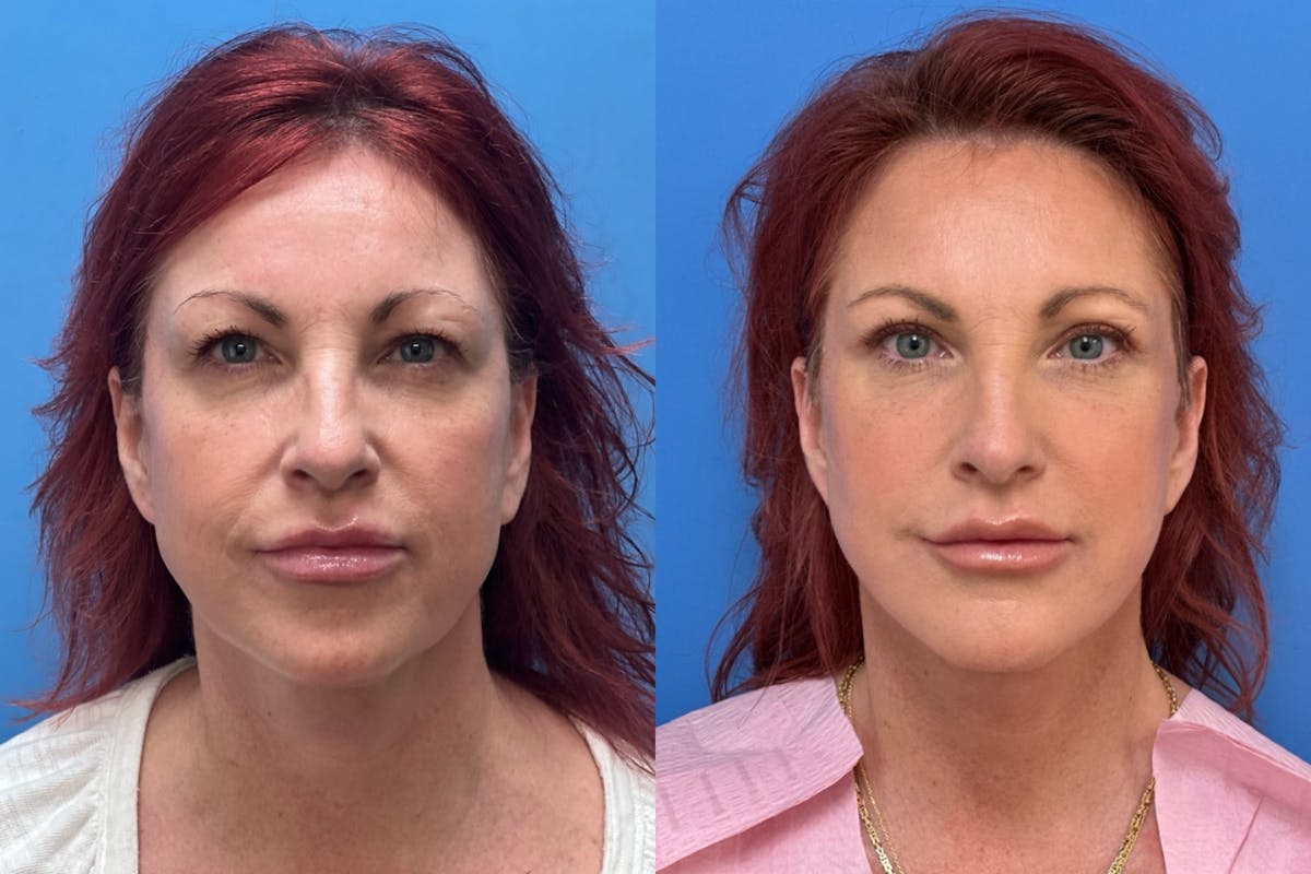 Chemical Peel Before & After Gallery - Patient 337870 - Image 1