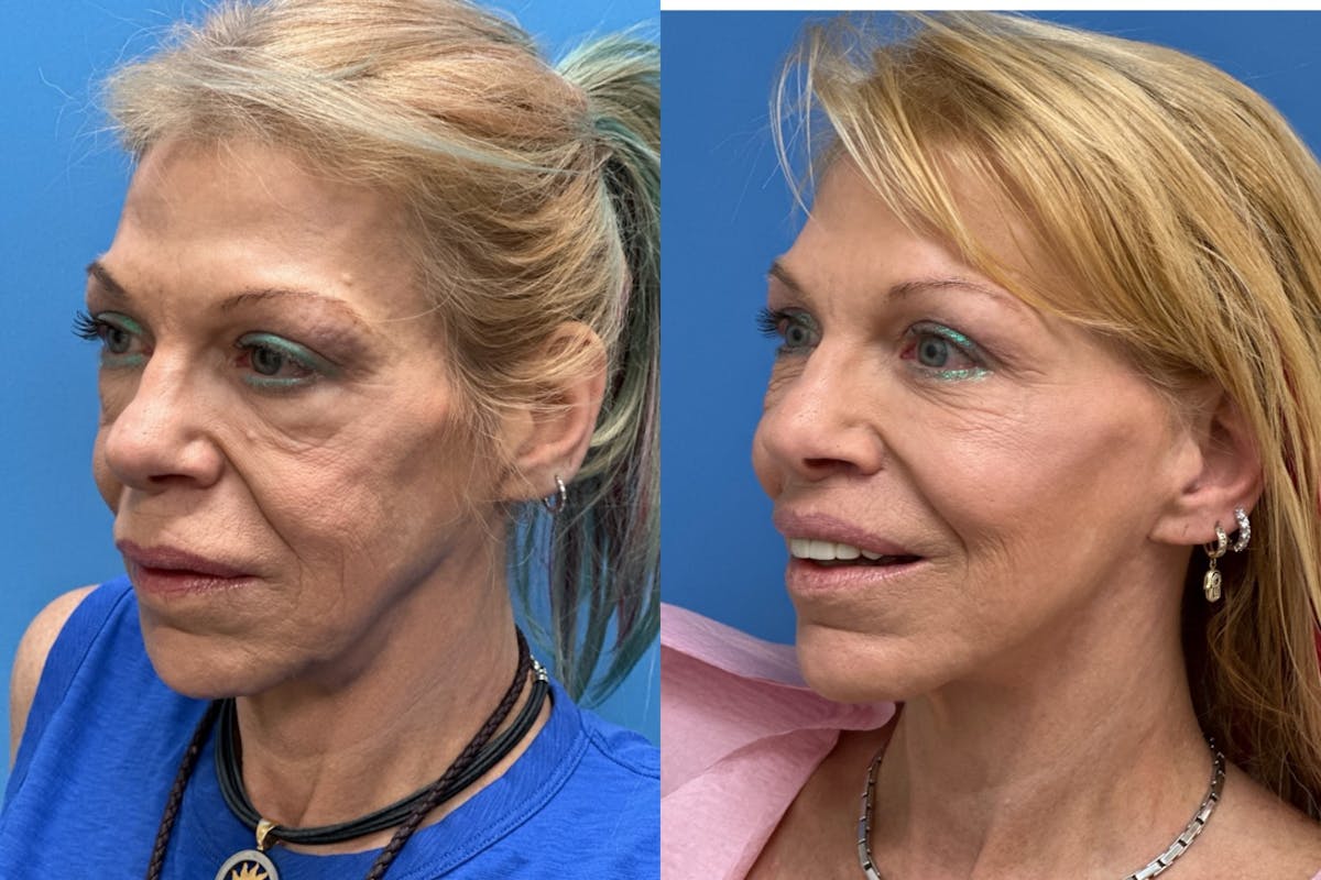 Neck Lift Before & After Gallery - Patient 337494 - Image 2