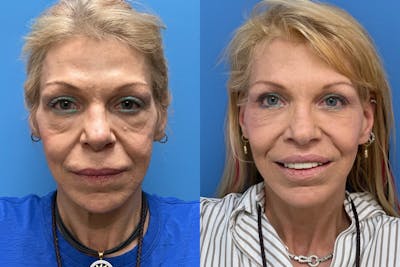 Facelift Before & After Gallery - Patient 818372 - Image 1