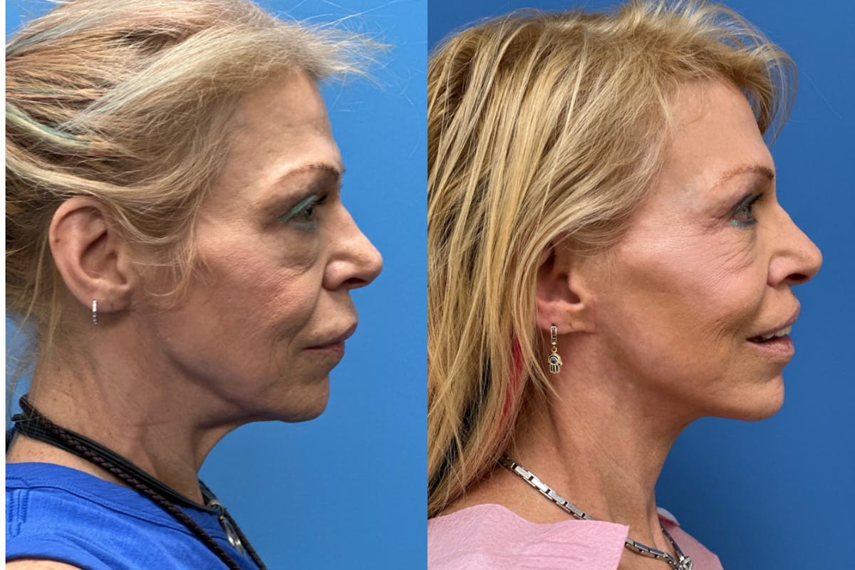 Neck Lift Before & After Gallery - Patient 337494 - Image 3