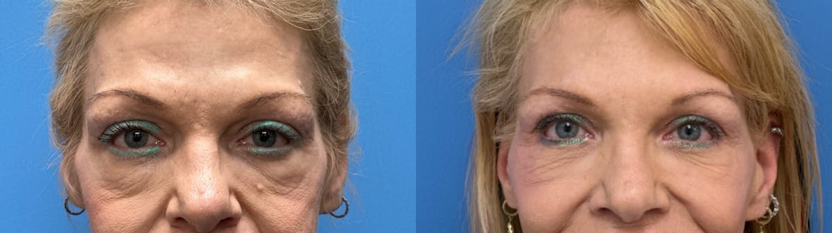 Eyelid Surgery Before & After Gallery - Patient 212904 - Image 1