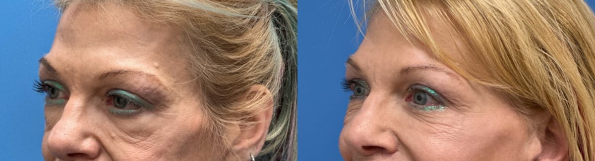 Eyelid Surgery Before & After Gallery - Patient 212904 - Image 2