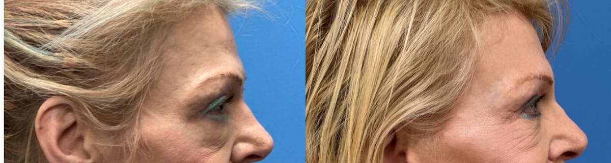 Eyelid Surgery Before & After Gallery - Patient 212904 - Image 3