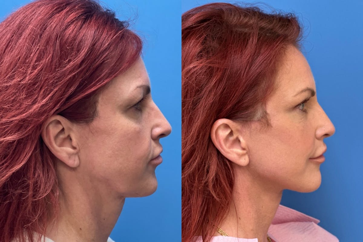 Facelift Before & After Gallery - Patient 118403 - Image 3