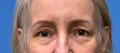 Eyelid Surgery Before & After Gallery - Patient 101927 - Image 1
