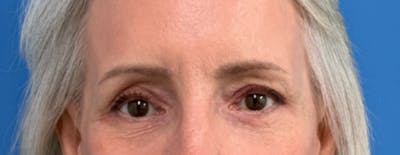 Eyelid Surgery Before & After Gallery - Patient 101927 - Image 2