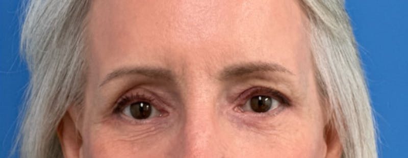 Eyelid Surgery Before & After Gallery - Patient 101927 - Image 2