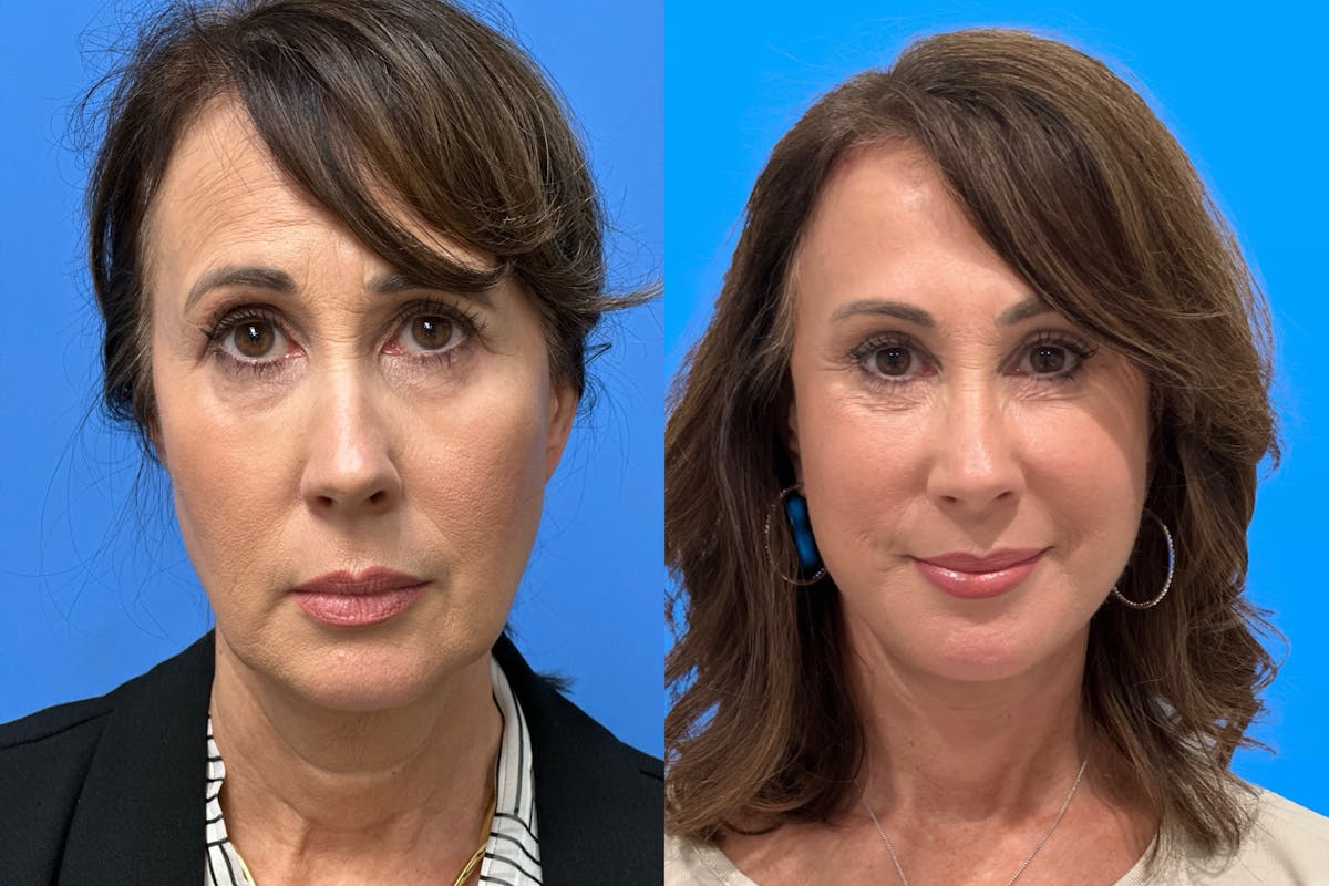 Facelift Before & After Gallery - Patient 666015 - Image 1