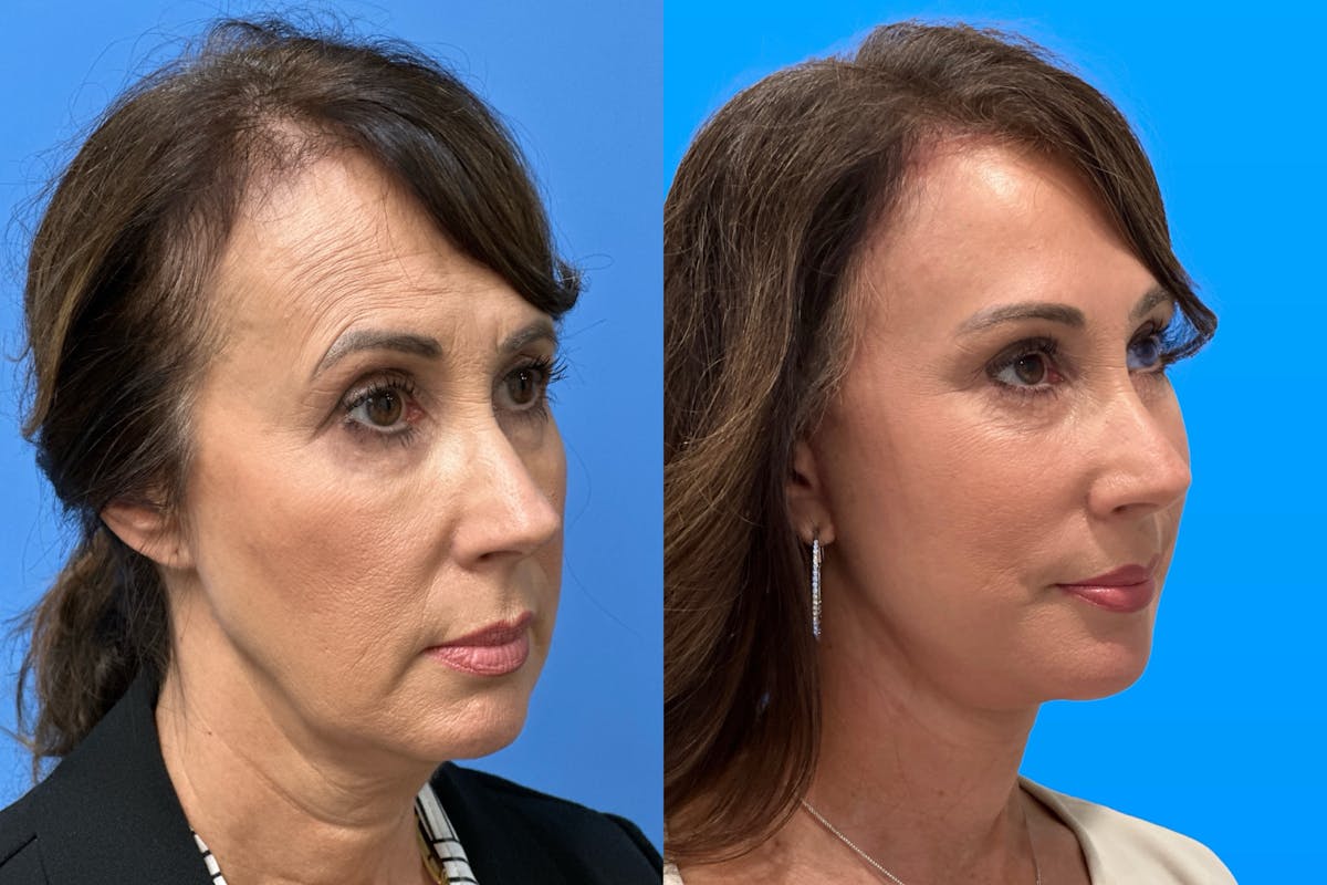 Facelift Before & After Gallery - Patient 666015 - Image 2