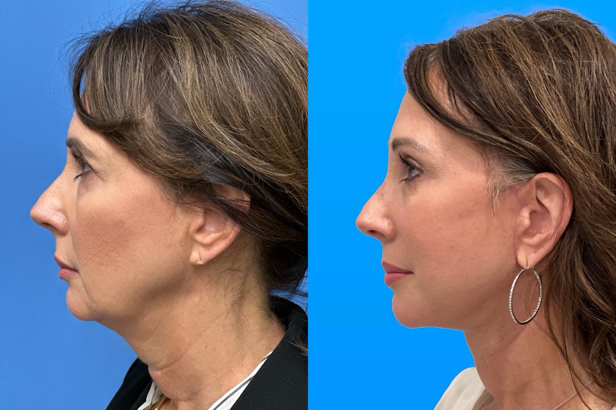 Facelift Before & After Gallery - Patient 666015 - Image 3