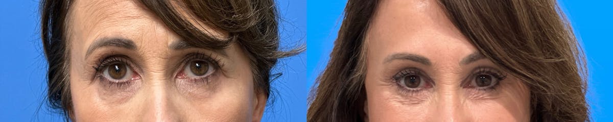 Eyelid Surgery Before & After Gallery - Patient 506063 - Image 1