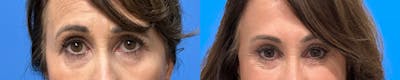 Eyelid Surgery Before & After Gallery - Patient 506063 - Image 1