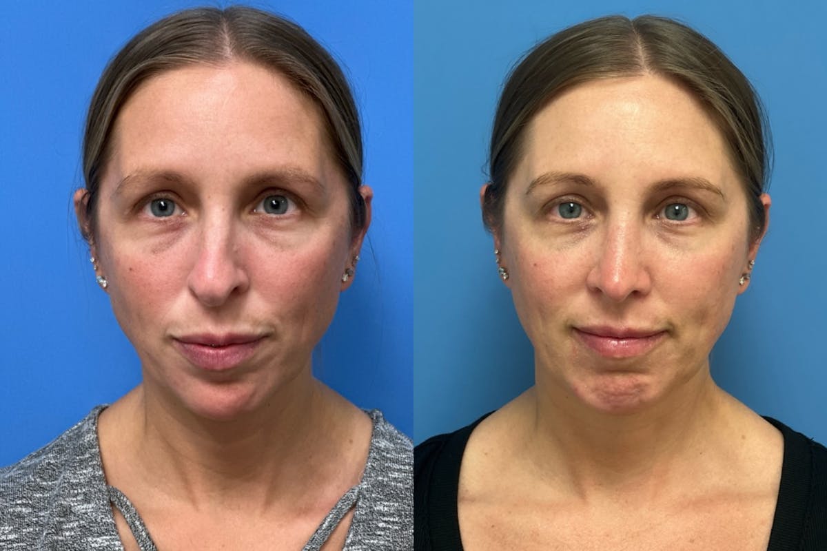 Rhinoplasty Before & After Gallery - Patient 946393 - Image 2