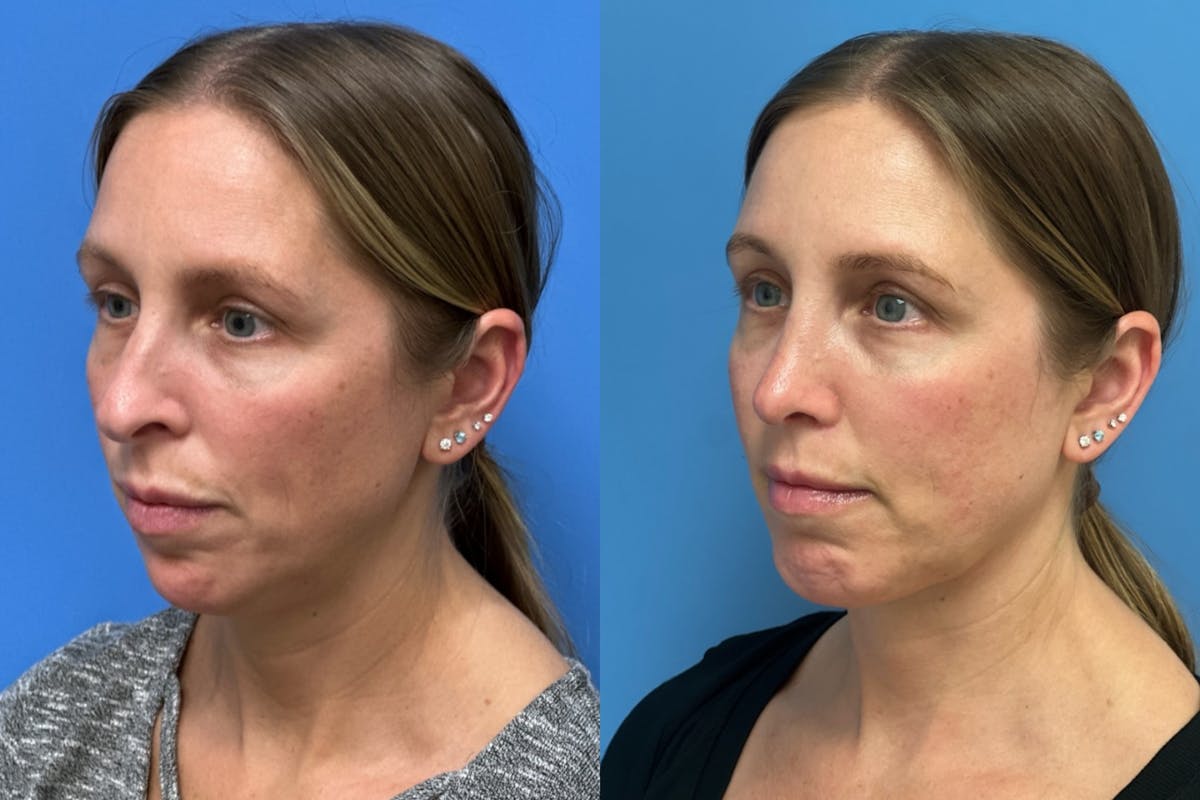 Rhinoplasty Before & After Gallery - Patient 946393 - Image 3