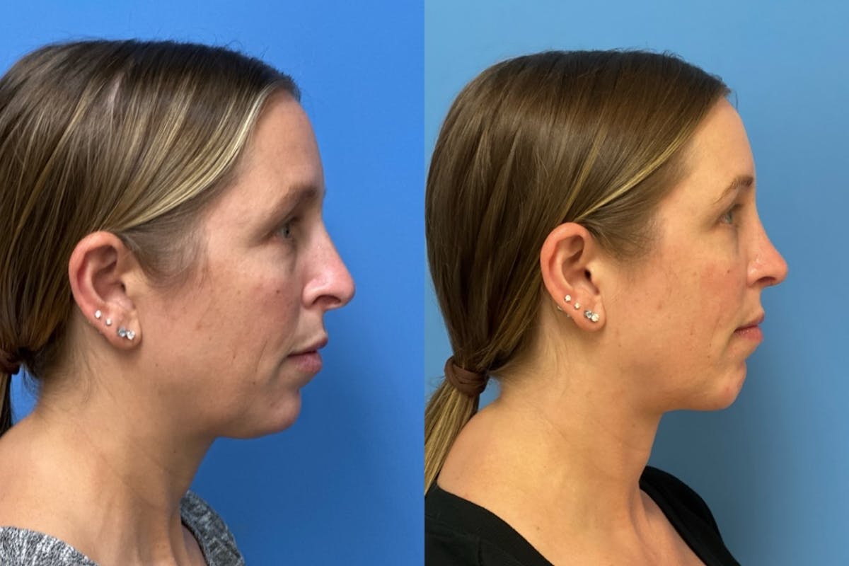 Rhinoplasty Before & After Gallery - Patient 946393 - Image 1