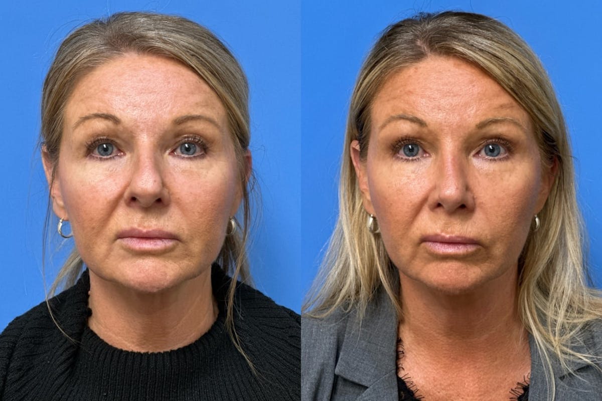 Rhinoplasty Before & After Gallery - Patient 402411 - Image 2