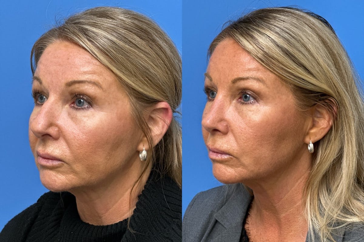 Rhinoplasty Before & After Gallery - Patient 402411 - Image 3