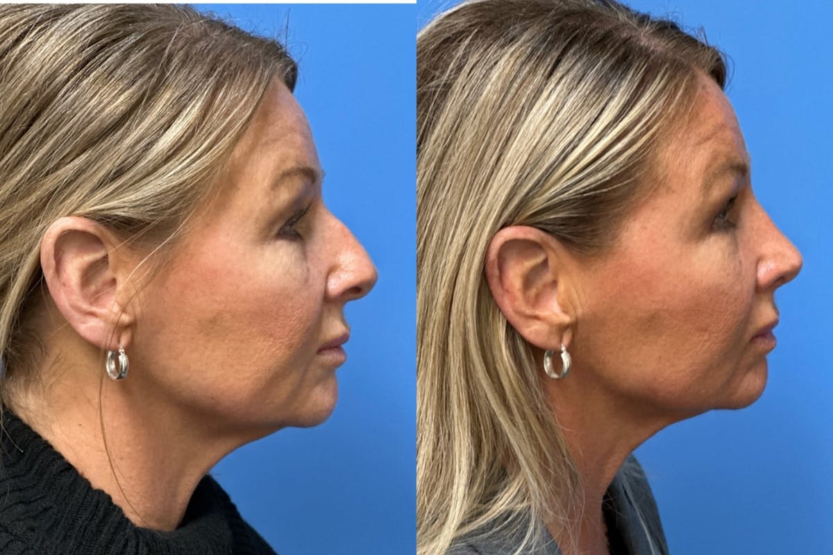 Rhinoplasty Before & After Gallery - Patient 402411 - Image 1