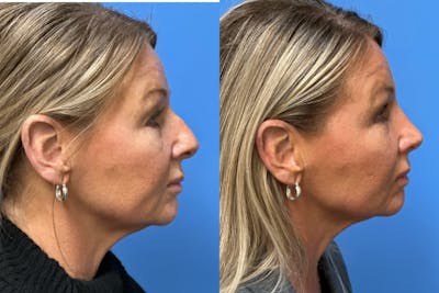 Rhinoplasty Before & After Gallery - Patient 402411 - Image 1