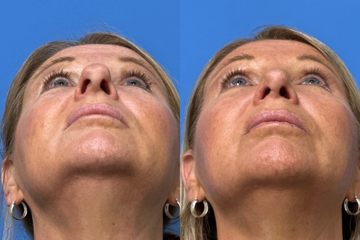 Rhinoplasty Before & After Gallery - Patient 402411 - Image 4