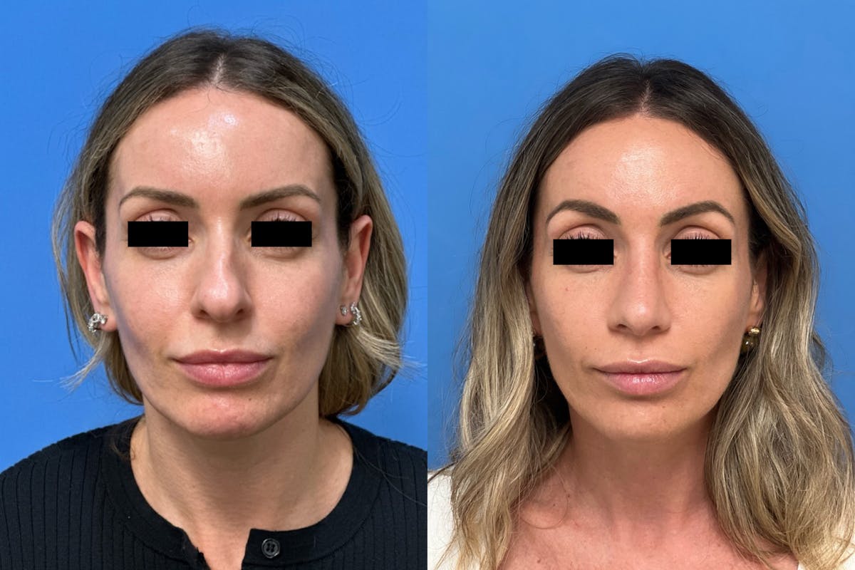 Rhinoplasty Before & After Gallery - Patient 211107 - Image 2