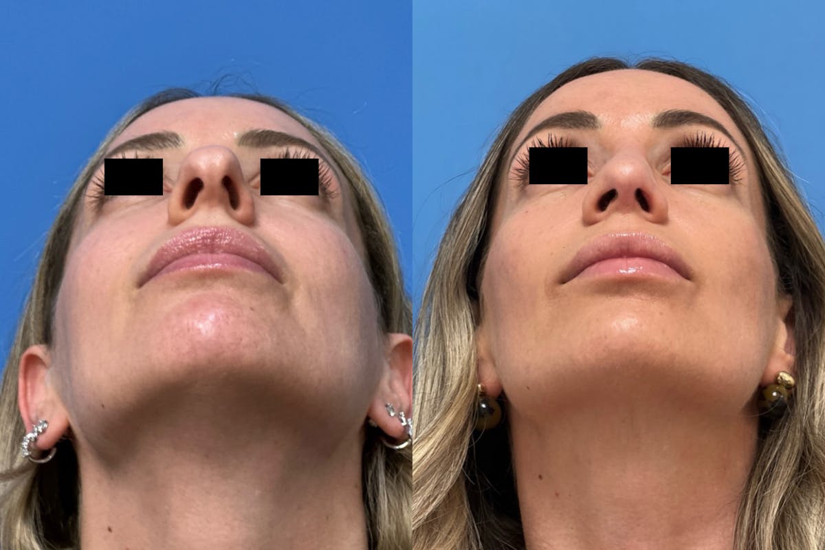 Rhinoplasty Before & After Gallery - Patient 211107 - Image 4