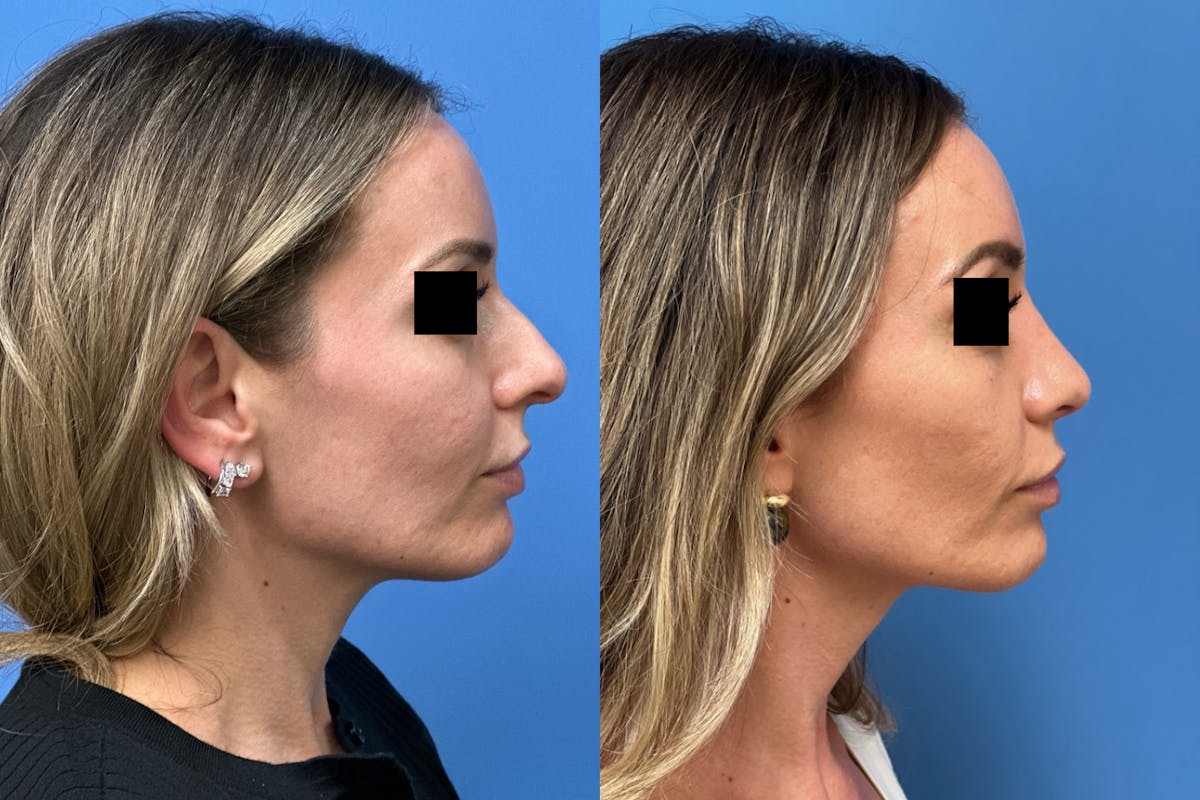 Rhinoplasty Before & After Gallery - Patient 211107 - Image 1