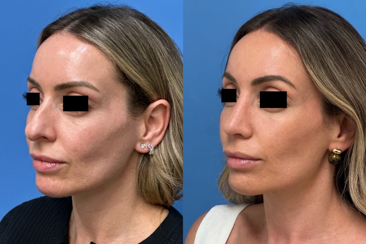 Rhinoplasty Before & After Gallery - Patient 211107 - Image 3