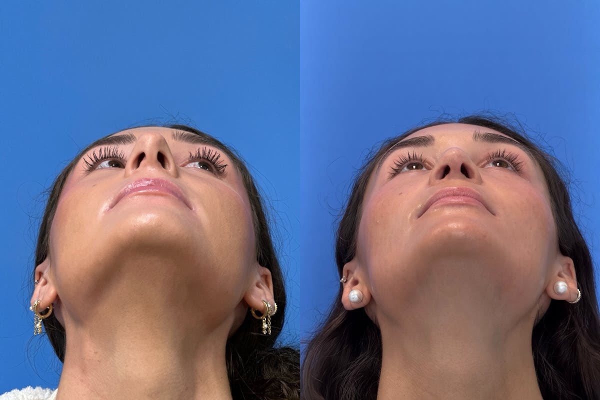 Rhinoplasty Before & After Gallery - Patient 379822 - Image 4