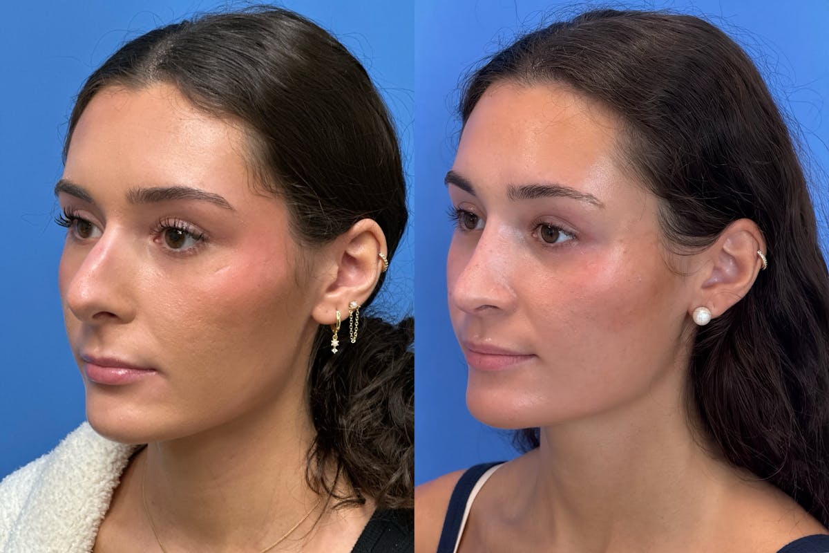 Rhinoplasty Before & After Gallery - Patient 379822 - Image 3