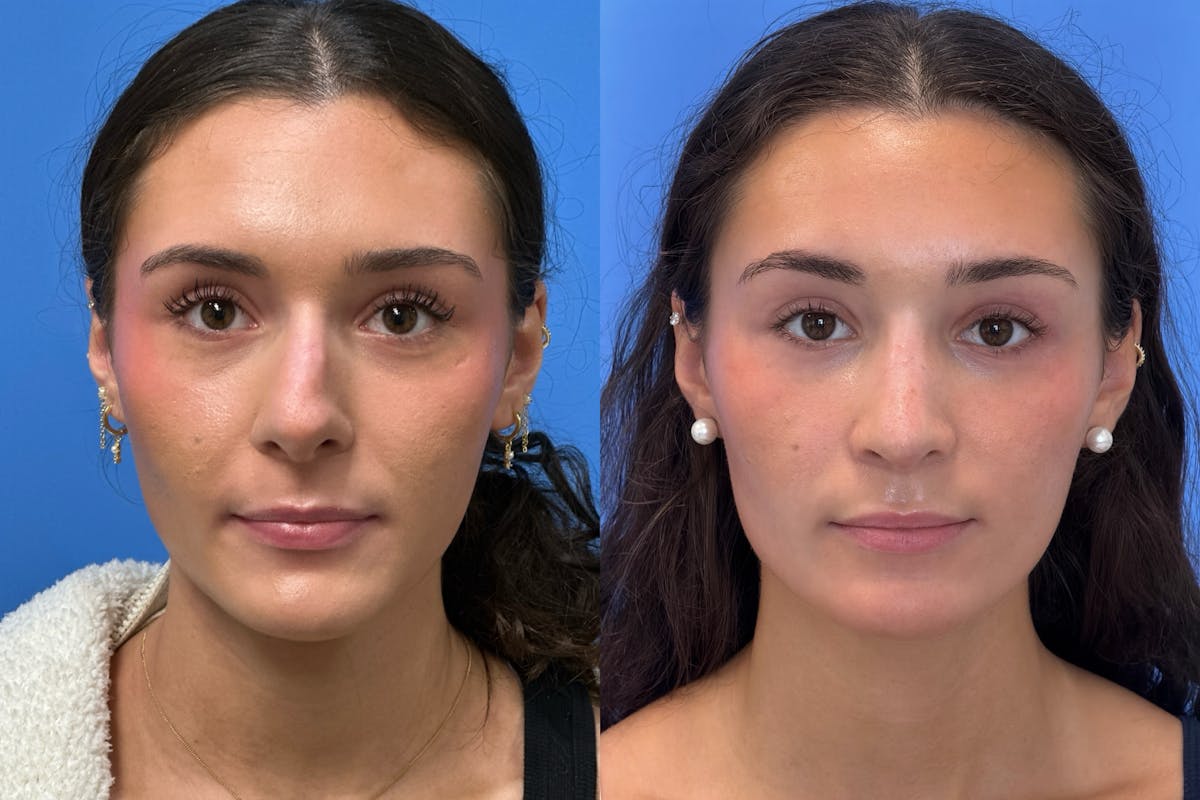 Rhinoplasty Before & After Gallery - Patient 379822 - Image 2