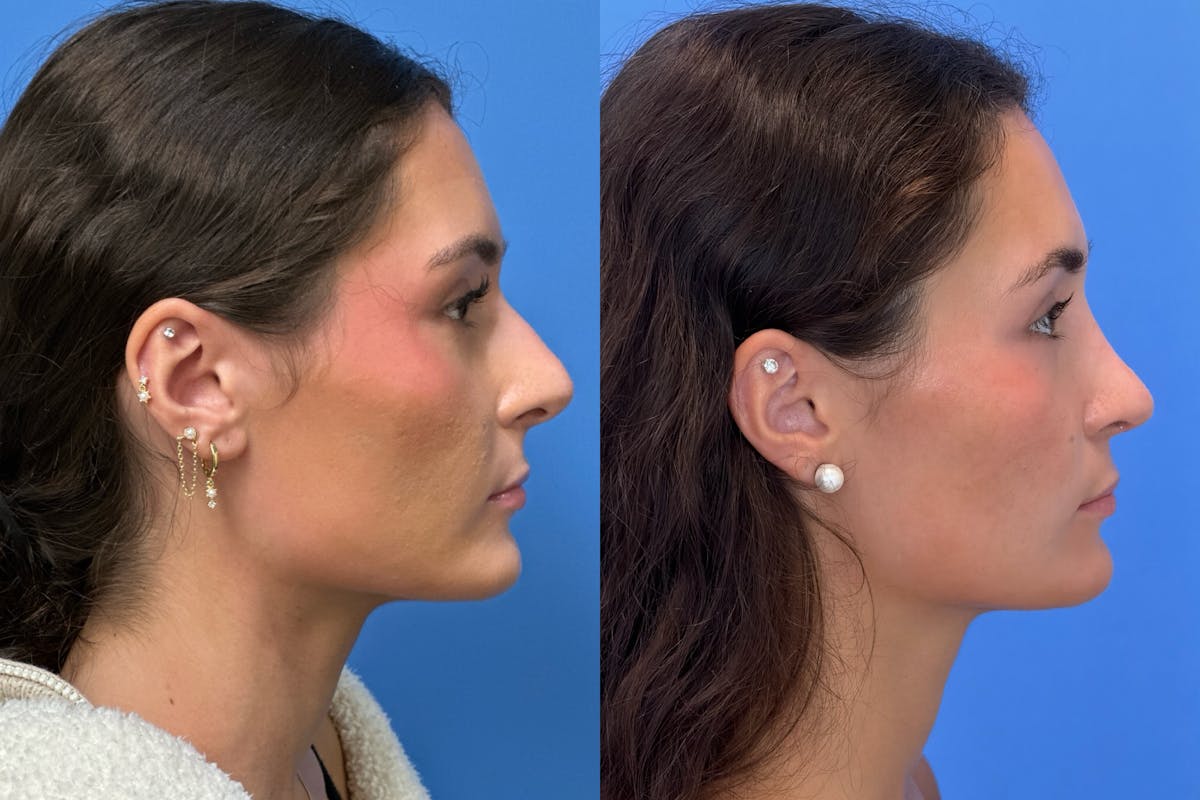 Rhinoplasty Before & After Gallery - Patient 379822 - Image 1
