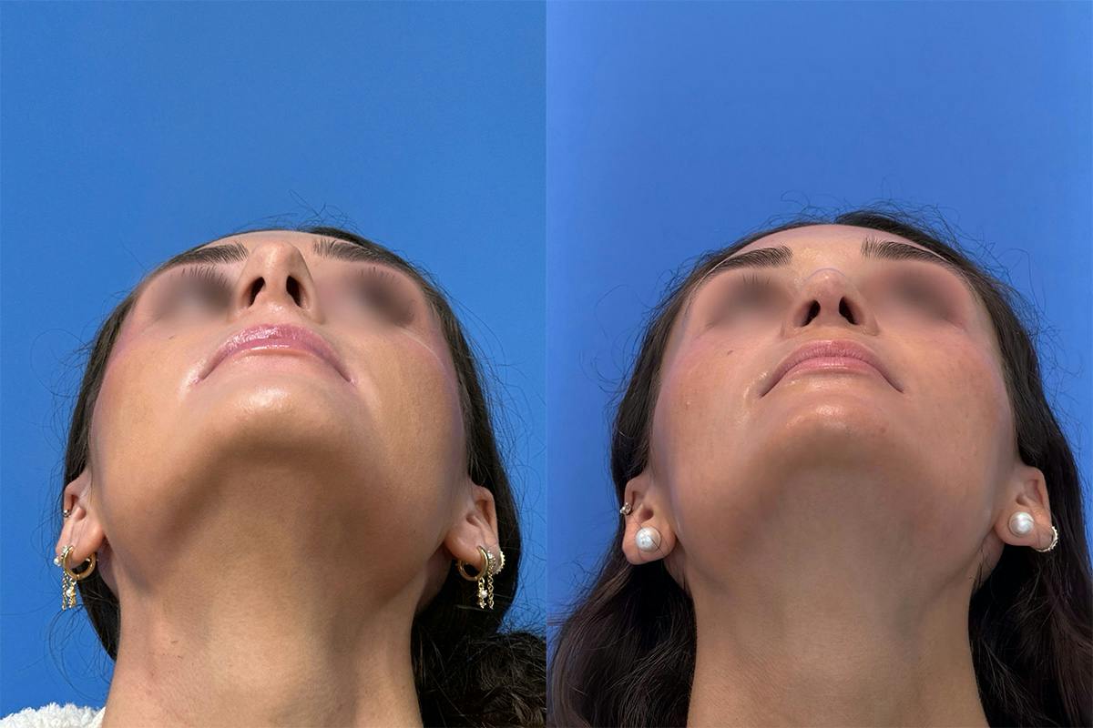 Rhinoplasty Before & After Gallery - Patient 379822 - Image 4