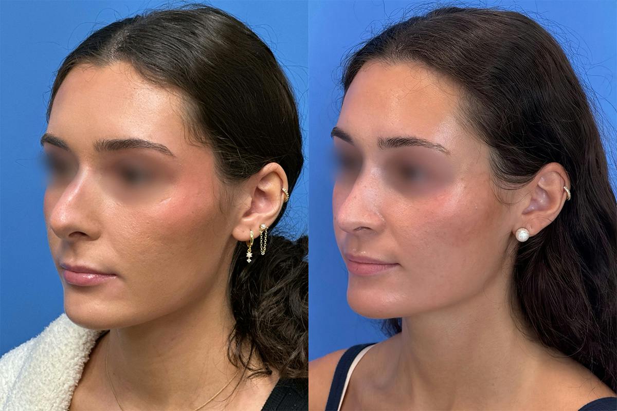 Rhinoplasty Before & After Gallery - Patient 379822 - Image 3