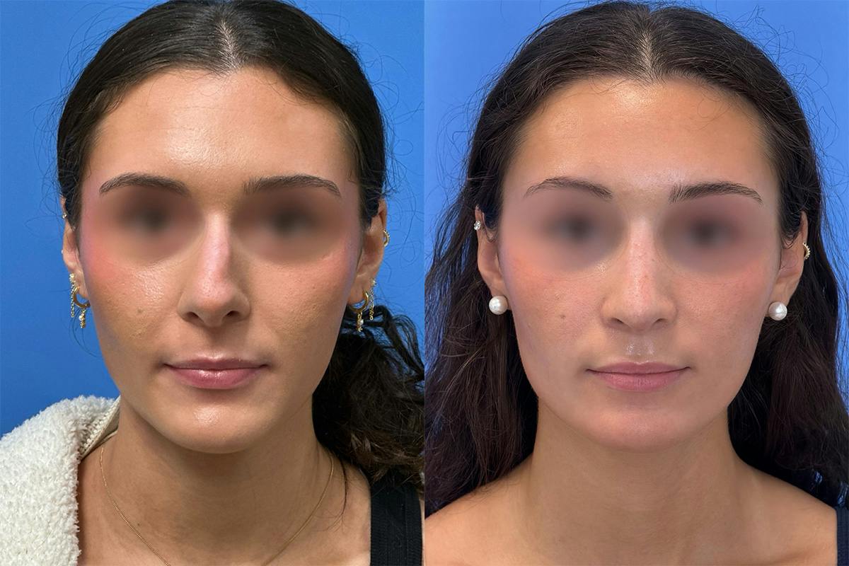 Rhinoplasty Before & After Gallery - Patient 379822 - Image 2