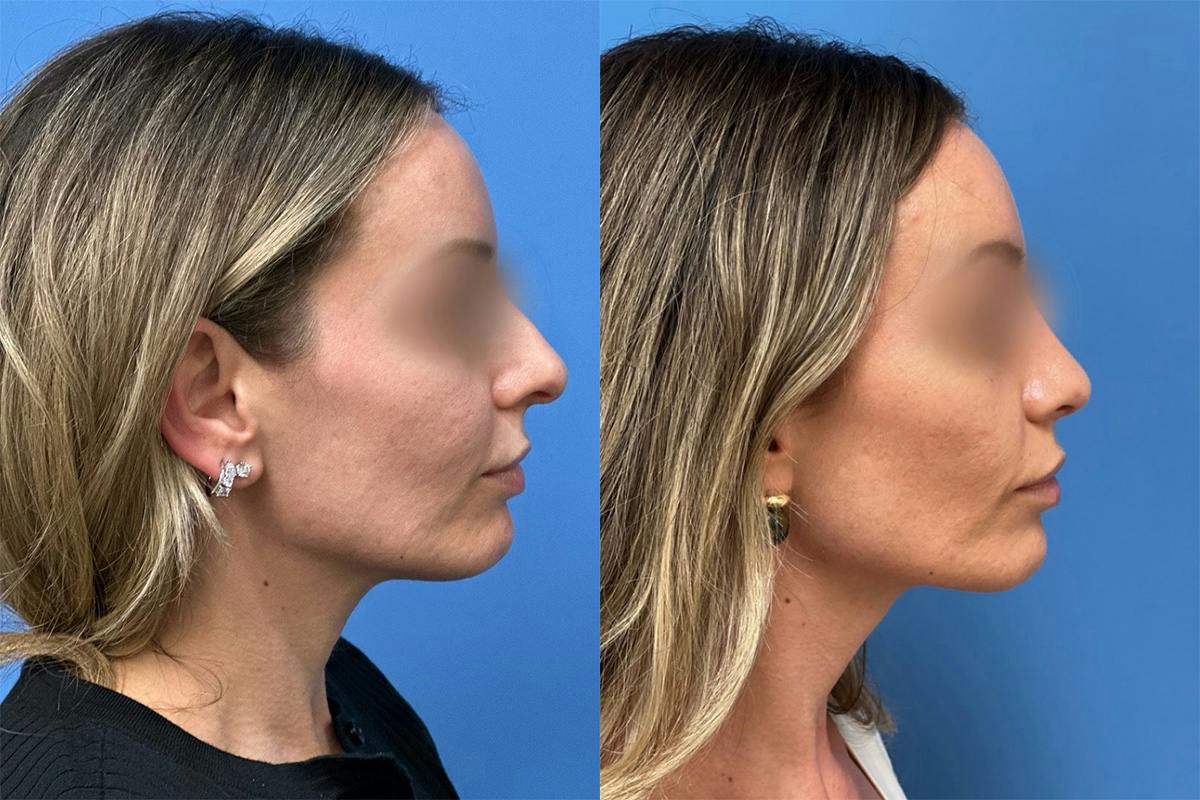 Rhinoplasty Before & After Gallery - Patient 211107 - Image 1