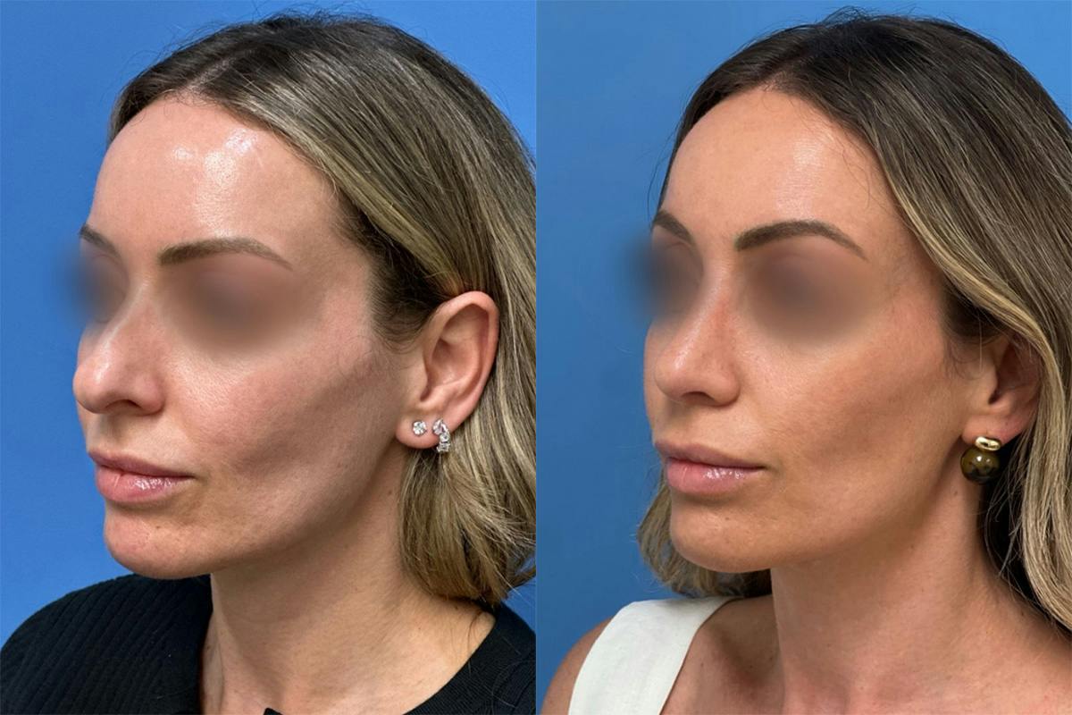 Rhinoplasty Before & After Gallery - Patient 211107 - Image 3