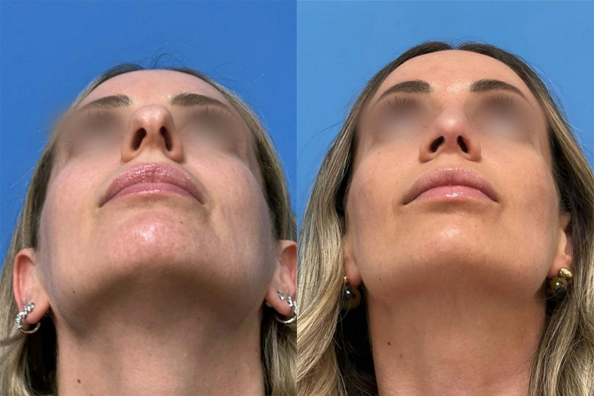 Rhinoplasty Before & After Gallery - Patient 211107 - Image 4