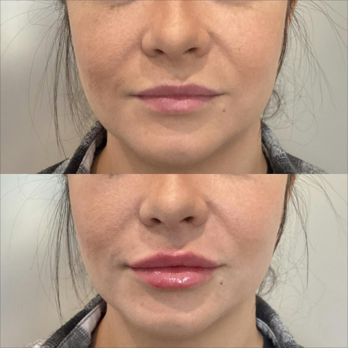 Lip Filler Before & After Gallery - Patient 170500 - Image 3