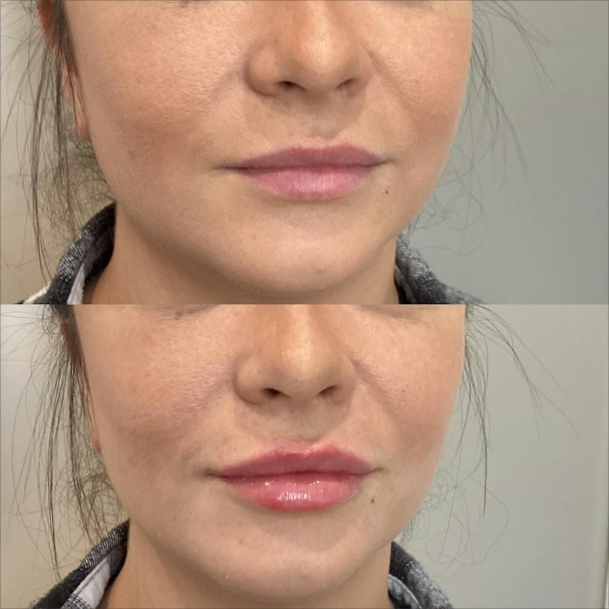 Lip Filler Before & After Gallery - Patient 170500 - Image 1