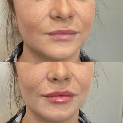 Lip Filler Before & After Gallery - Patient 170500 - Image 1