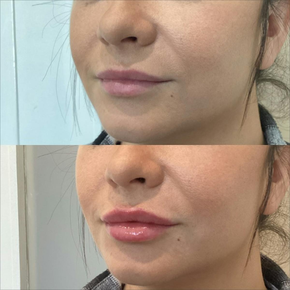 Lip Filler Before & After Gallery - Patient 170500 - Image 2